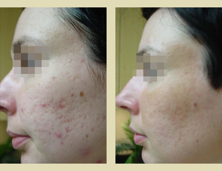 Fraxel laser treatment before & after pictures Fraxel laser treatment before & after pictures