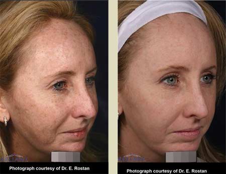 Fraxel laser treatment before & after pictures Fraxel laser treatment before & after pictures