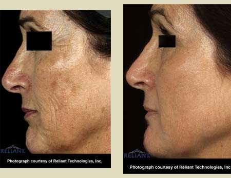 Fraxel laser treatment before & after pictures Fraxel laser treatment before & after pictures