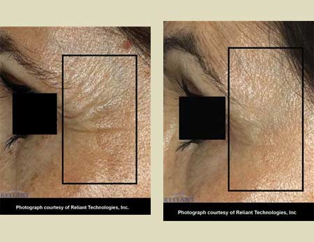 Fraxel laser treatment before & after pictures Fraxel laser treatment before & after pictures