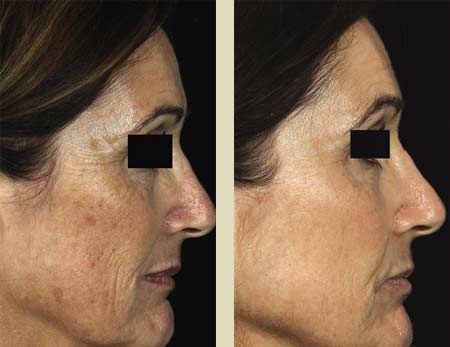 Fraxel laser treatment before & after pictures Fraxel laser treatment before & after pictures