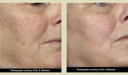 Fraxel laser treatment before & after pictures Fraxel laser treatment before & after pictures