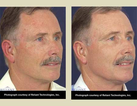 Fraxel laser treatment before & after pictures Fraxel laser treatment before & after pictures