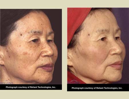 Fraxel laser treatment before & after pictures Fraxel laser treatment before & after pictures