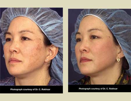 Fraxel laser treatment before & after pictures Fraxel laser treatment before & after pictures