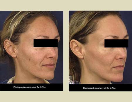 Fraxel laser treatment before & after pictures Fraxel laser treatment before & after pictures