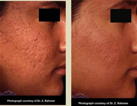 Fraxel laser treatment before & after pictures Fraxel laser treatment before & after pictures