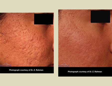 Fraxel laser treatment before & after pictures Fraxel laser treatment before & after pictures