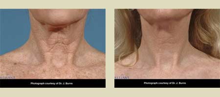Fraxel laser treatment before & after pictures Fraxel laser treatment before & after pictures