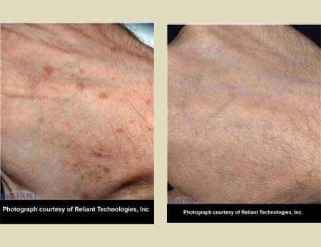 Fraxel laser treatment before & after pictures Fraxel laser treatment before & after pictures
