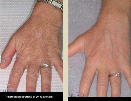 Fraxel laser treatment before & after pictures Fraxel laser treatment before & after pictures