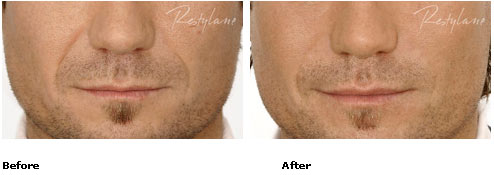 Restylane - Nasolabial Folds - Before & After Pictures Restylane - Nasolabial Folds - Before & After Pictures