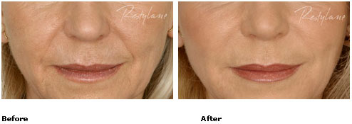 Restylane - Nasolabial Folds - Before & After Pictures Restylane - Nasolabial Folds - Before & After Pictures