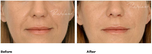 Restylane - Nasolabial Folds - Before & After Pictures Restylane - Nasolabial Folds - Before & After Pictures