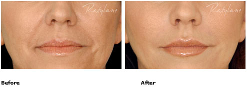 Restylane - Nasolabial Folds - Before & After Pictures Restylane - Nasolabial Folds - Before & After Pictures