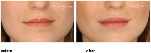 Restylane - Lips - Before & After Pictures Restylane - Lips - Before & After Pictures