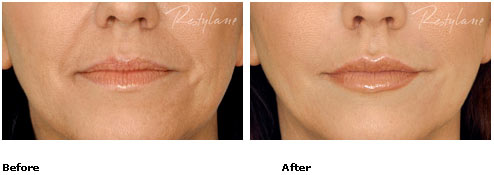 Restylane - Lips - Before & After Pictures Restylane - Lips - Before & After Pictures