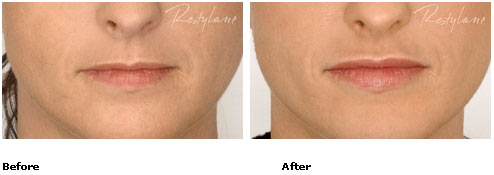 Restylane - Lips - Before & After Pictures Restylane - Lips - Before & After Pictures