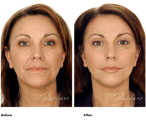 Restylane - Full Face - Before & After Pictures Restylane - Full Face - Before & After Pictures