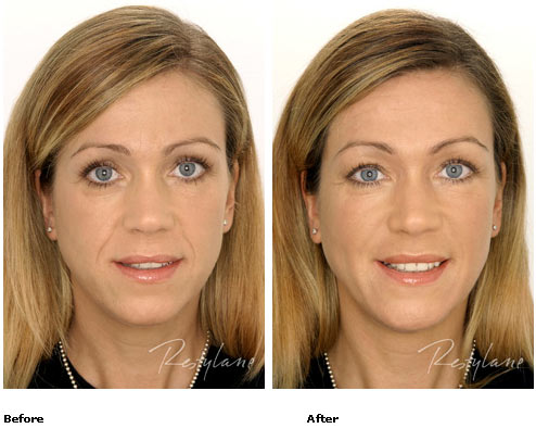 Restylane - Full Face - Before & After Pictures Restylane - Full Face - Before & After Pictures