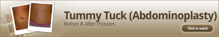 Tummy Tuck (Abdominoplasty) – Before & After Pictures
