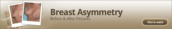 Breast Asymmetry – Before and After Pictures Breast Asymmetry – Before and After Pictures