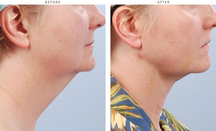 Cool Lipo - Laser liposuction Chicago Cool Lipo - Laser liposuction Chicago