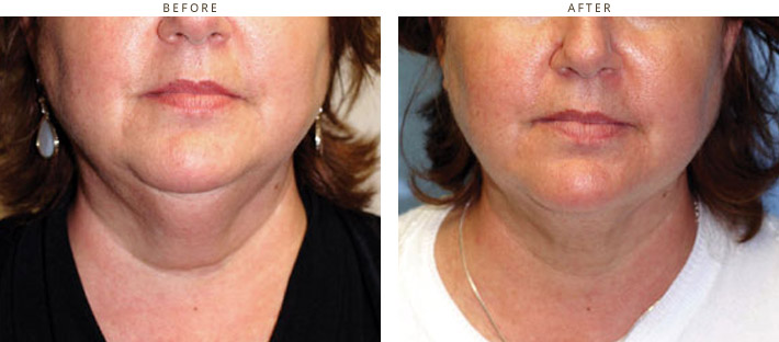 Cool Lipo - Laser liposuction Chicago Cool Lipo - Laser liposuction Chicago