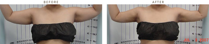 Cool Lipo - Laser liposuction Chicago Cool Lipo - Laser liposuction Chicago