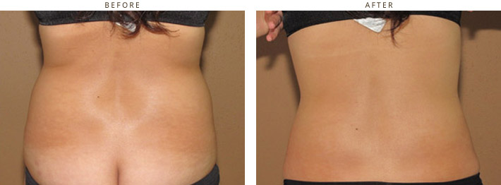 Cool Lipo - Laser liposuction Chicago Cool Lipo - Laser liposuction Chicago