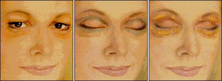 Eyelid lift surgery Eyelid lift surgery