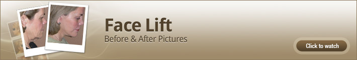 Face Lift - Before and After Pictures Face Lift - Before and After Pictures
