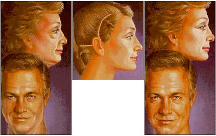 face lift chicago face lift chicago