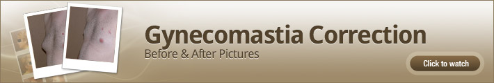 Gynecomastia Correction – Before and After Pictures Gynecomastia Correction – Before and After Pictures