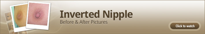 Inverted Nipple – Before and After Pictures Inverted Nipple – Before and After Pictures