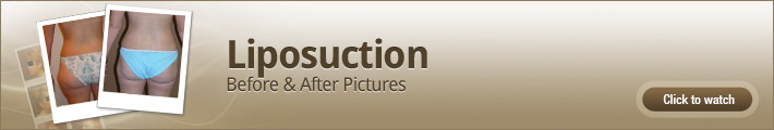 Liposuction – Before & After Pictures Liposuction – Before & After Pictures