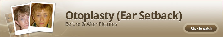 Otoplasty (Ear Setback) – Before & After Pictures Otoplasty (Ear Setback) – Before & After Pictures