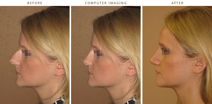 Plastic Surgery Computer Imaging Plastic Surgery Computer Imaging