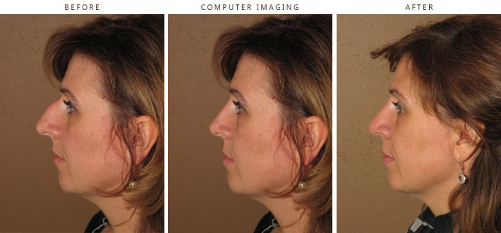 Plastic Surgery Computer Imaging Plastic Surgery Computer Imaging