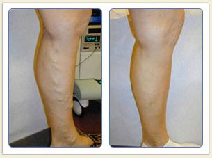 Varicose veins and broken vessels removal 01 Varicose veins and broken vessels removal 01