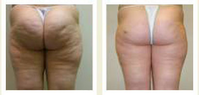 Velasmooth Chicago Velasmooth Chicago