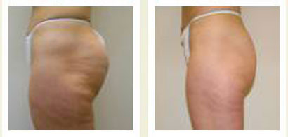 Velasmooth Chicago Velasmooth Chicago