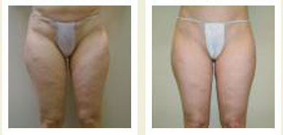 Velasmooth Chicago Velasmooth Chicago