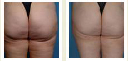 Velasmooth Chicago Velasmooth Chicago