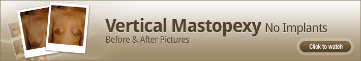 Vertical Mastopexy (breast lift) no implants Breast lift (mastopexy) Chicago